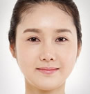 韩国高兰得开眼角和双眼皮整形手术前后对比照片