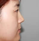 鼻部整形手术前后对比照片_术后