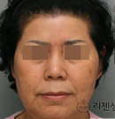 韩国丽珍整形医院-面部抗衰老整形对比日记