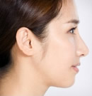 韩国高兰得驼峰鼻矫正、垫下巴手术前后对比照片_术后