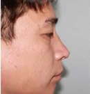 韩国赫尔希整形医院-鼻微整形前后对比照片