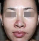 鼻部整形手术前后对比照片_术前