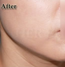 韩国赫尔希整形医院-改善双下巴整形前后对比照片