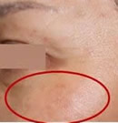 韩国赫尔希整形医院-面部色斑去除前后对比照片