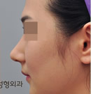 韩国丽珍整形医院-鹰钩鼻矫正手术对比日记
