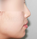 鼻子、下巴注射玻尿酸整形前后对比照片_术后