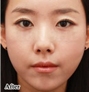 韩国赫尔希整形医院-Lipokit生物脂肪移植术前后对比照片