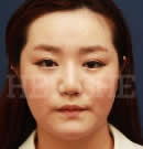 韩国赫尔希整形医院-面部轮廓整形术前后对比照片