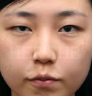 韩国赫尔希整形医院-眼部整形手术前后对比照片
