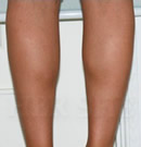 韩国赫尔希整形医院-注射瘦脸针瘦小腿前后对比照片