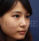韩国赫尔希整形医院-假体隆鼻整形术前后对比照片