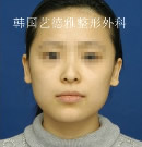 韩国艺德雅整形双鄂手术矫正案例