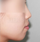鼻子、下巴注射玻尿酸整形前后对比照片_术前