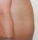 韩国赫尔希整形医院-水射流腹部吸脂术前后对比照片