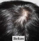韩国赫尔希整形医院-头发移植术前后对比照片