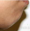 韩国赫尔希整形医院-下巴填充整形手术前后对比照片