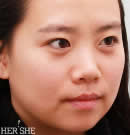 韩国赫尔希整形医院-Accusculpt面部吸脂手术前后对比照片