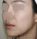韩国赫尔希整形医院-脂肪移植&皮肤再生前后对比照片