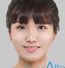 韩国高兰得整形外科面部轮廓手术前后照片_术后