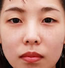 韩国赫尔希整形医院-双眼皮整形前后对比照片