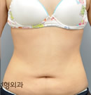 韩国丽珍整形医院-腰腹吸脂整形对比日记