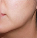 韩国赫尔希整形医院-面部吸脂手术前后对比照片