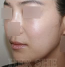 韩国赫尔希整形医院-脂肪移植&皮肤再生前后对比照片