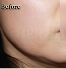 韩国赫尔希整形医院-改善双下巴整形前后对比照片