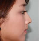 韩国赫尔希整形医院-自体软骨隆鼻手术前后对比照片