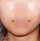 韩国赫尔希整形医院-botox瘦下巴整形前后对比照片