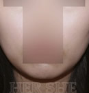 韩国赫尔希整形医院-注射玻尿酸瘦下巴前后对比照片