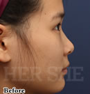 韩国赫尔希整形医院-line鼻部整形对比案例