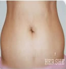 韩国赫尔希整形医院-腰部吸脂整形术前后对比照片