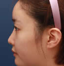 韩国赫尔希整形医院-Two-Line鼻整形手术前后对比照片