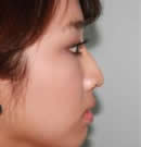韩国赫尔希整形医院-自体软骨隆鼻手术前后对比照片