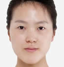 高兰得整形外科-韩国高兰得埋线法双眼皮整形手术前后对比照片