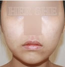 韩国赫尔希整形医院-V-pack脸部线条整形前后对比照片