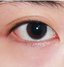韩国赫尔希整形医院-韩式双眼皮手术前后对比照片