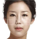 韩国赫尔希整形医院-眼部整形手术前后对比照片