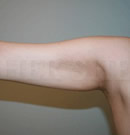 韩国赫尔希整形医院-手臂吸脂术前后对比照片