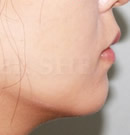 韩国赫尔希整形医院-下巴线条提升术前后对比照片