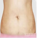 韩国赫尔希整形医院-腰部吸脂整形术前后对比照片