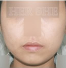 韩国赫尔希整形医院-V-pack脸部线条整形前后对比照片