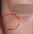 韩国赫尔希整形医院-皮肤再生术前后对比照片