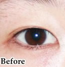 韩国赫尔希整形医院-韩式双眼皮整形术前后对比照片