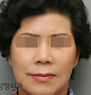 韩国丽珍整形医院-面部抗衰老整形对比案例