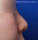韩国德琳整形外科-鼻头鼻尖整形手术对比案例