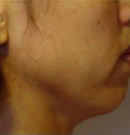 面部颈部提升术前后对比照片_术前