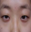 韩国德琳整形外科-双眼皮手术对比案例