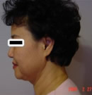 全脸和颈部提升除皱术前与术后8个月对比照片_术前